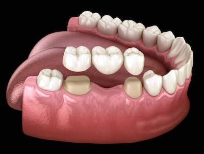 Diagram of dental bridge replacing missing teeth