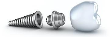Pieces of a dental implant at dentist in Flowery Branch GA