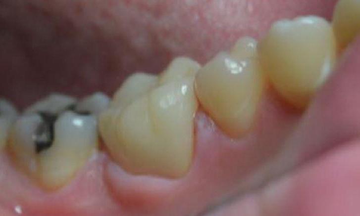 Composite-Tooth-Colored-Restoration-After-Image