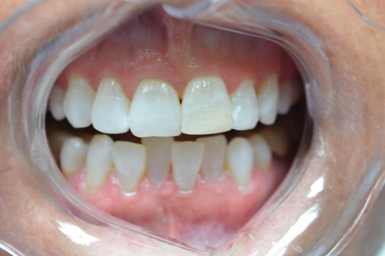 K-r-Teeth-Whitening-After-Image