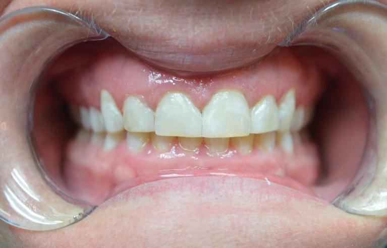 Space-Closure-Without-Braces-After-Image