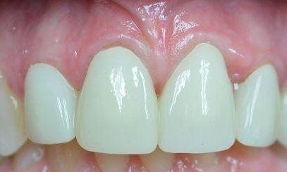 Full Anterior Crown Restoration flowery branch ga