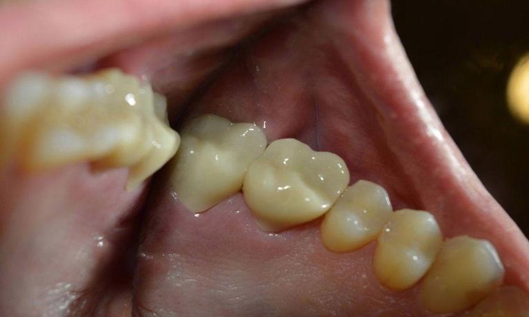 Large-Leaking-Silver-Fillings-Restored-with-Porcelain-Crowns-After-Image
