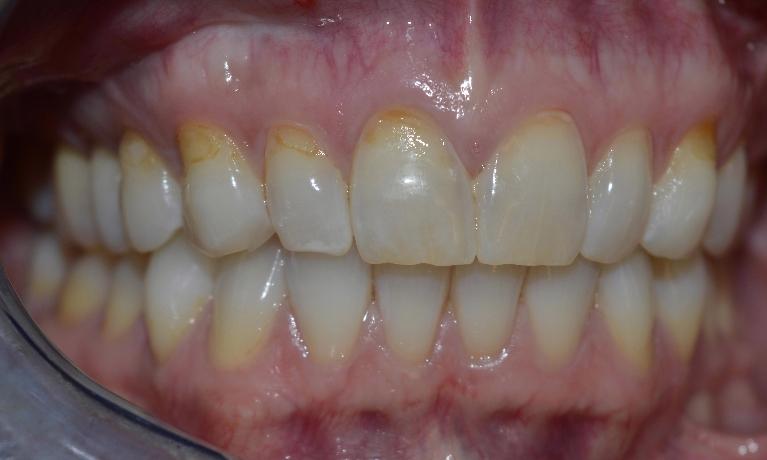 Composite-Tooth-Colored-Fillings-Brighten-Your-Smile-Before-Image