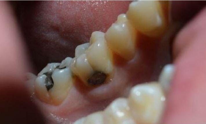 Composite-Tooth-Colored-Restoration-Before-Image