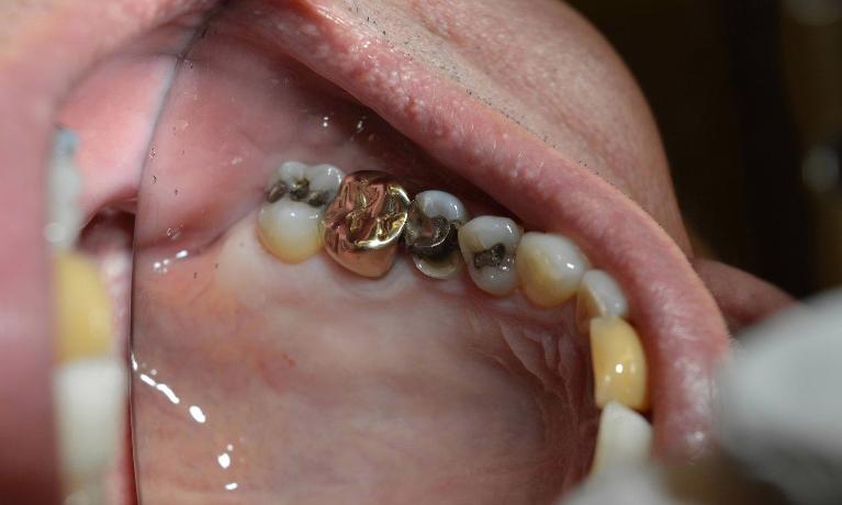 Fractured-Tooth-Restored-with-Porcelain-Crown-Before-Image