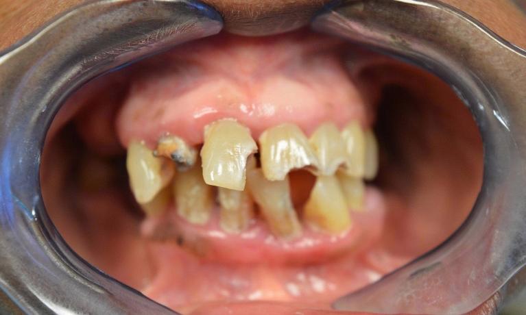 Custom-Dentures-Before-Image