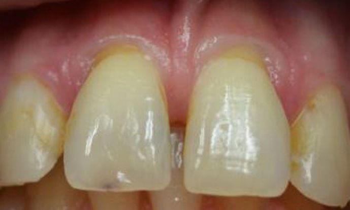 Full Anterior Crown Restoration flowery branch ga