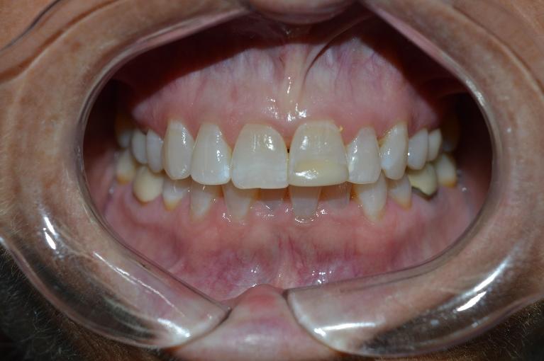 K-r-Teeth-Whitening-Before-Image