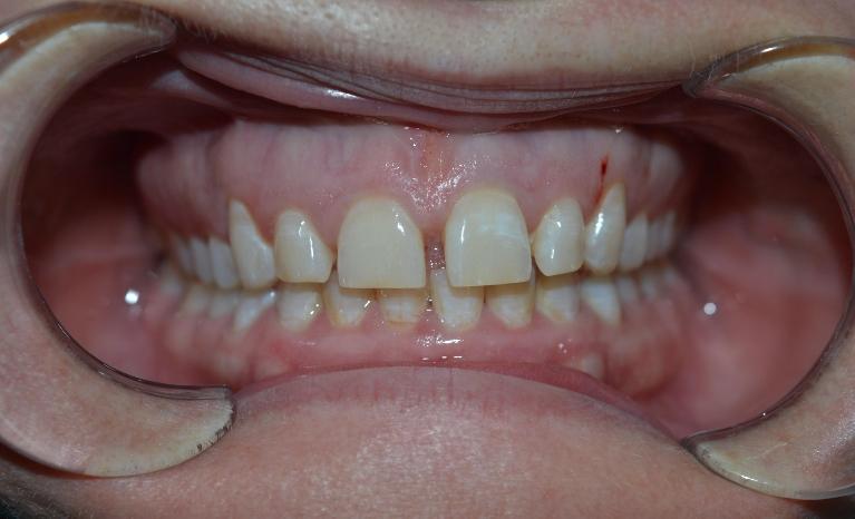 Space-Closure-Without-Braces-Before-Image