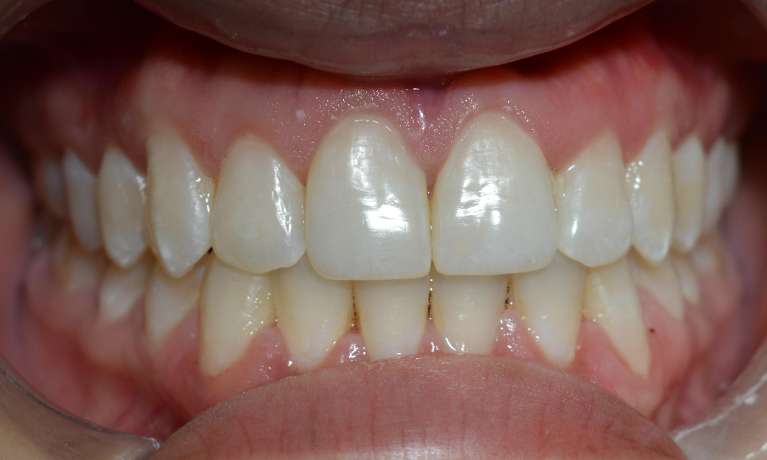 Before-and-After-with-Invislaign-After-Image
