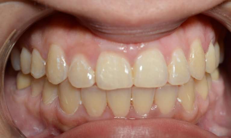 Before-and-After-with-Invislaign-After-Image