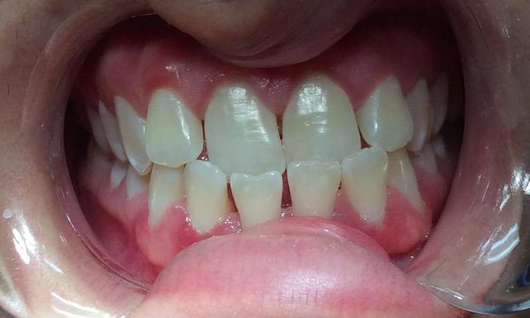 Before-and-After-with-Invislaign-Before-Image
