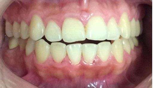 Before-and-After-with-Invislaign-Before-Image